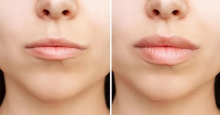 Lip Filler