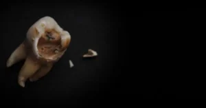 A tooth cracked in half with no pain may seem like an odd dental event—urgent, perhaps, but not uncomfortable enough to demand immediate attention.