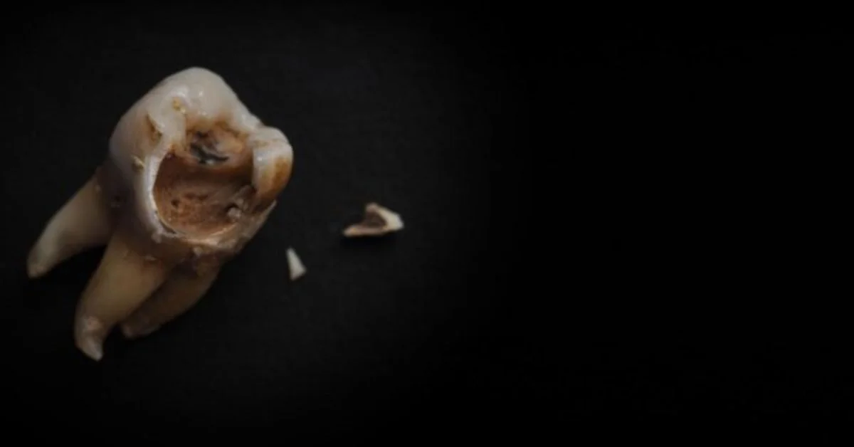 A tooth cracked in half with no pain may seem like an odd dental event—urgent, perhaps, but not uncomfortable enough to demand immediate attention.