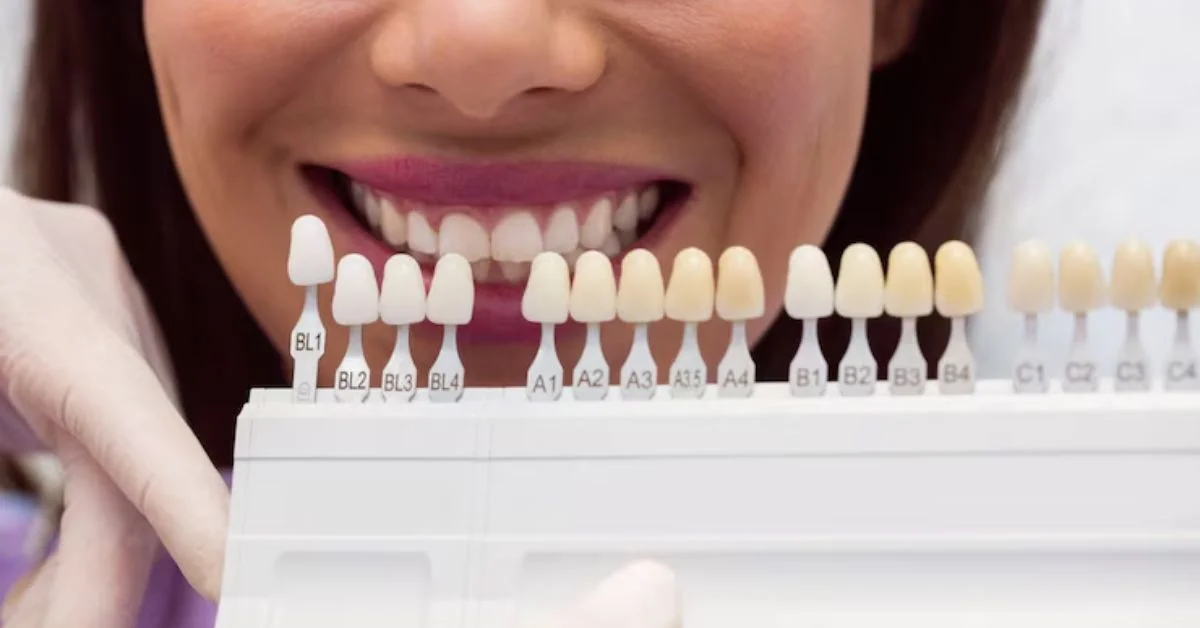 Veneers are thin shells, typically made from porcelain or composite resin, that are custom-designed to cover the front surface of teeth.